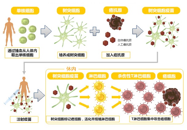 樹(shù)突細(xì)胞疫苗治療流程